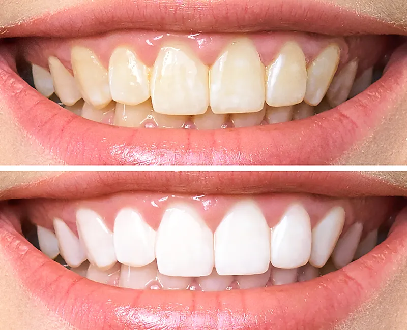 Vergleichsbild von gelben und weißen Zähnen